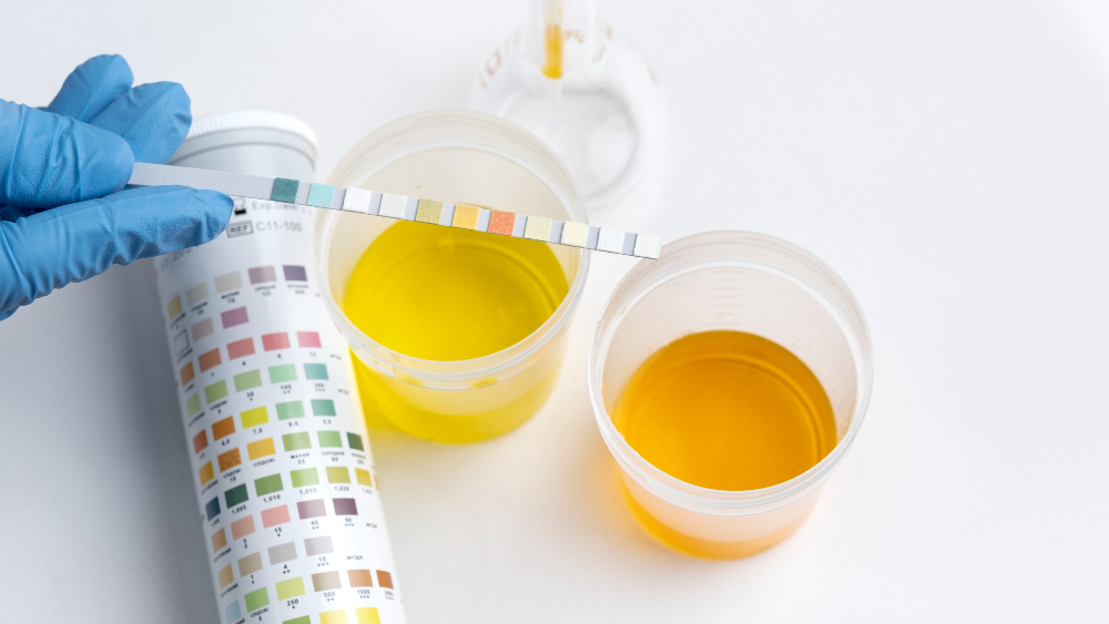 Pregnancy Urine Colour Guide  Did you notice a distinct change in